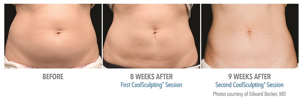 Newtown CoolSculpting before and after patient results