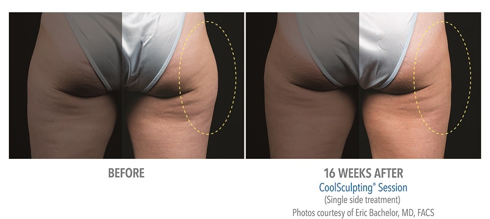newtown CoolSculpting before and after patient results