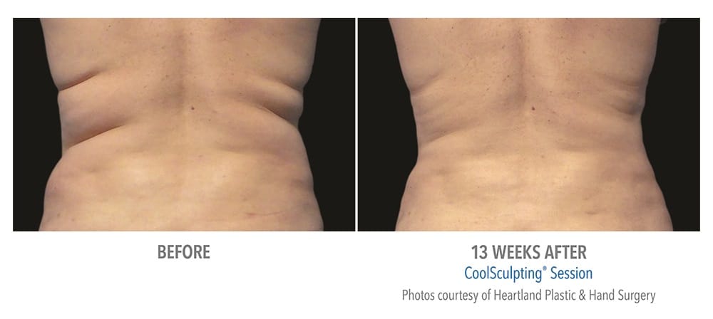 newtown CoolSculpting before and after patient results