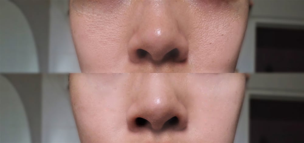 newtown large pore patient results