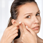 acne model