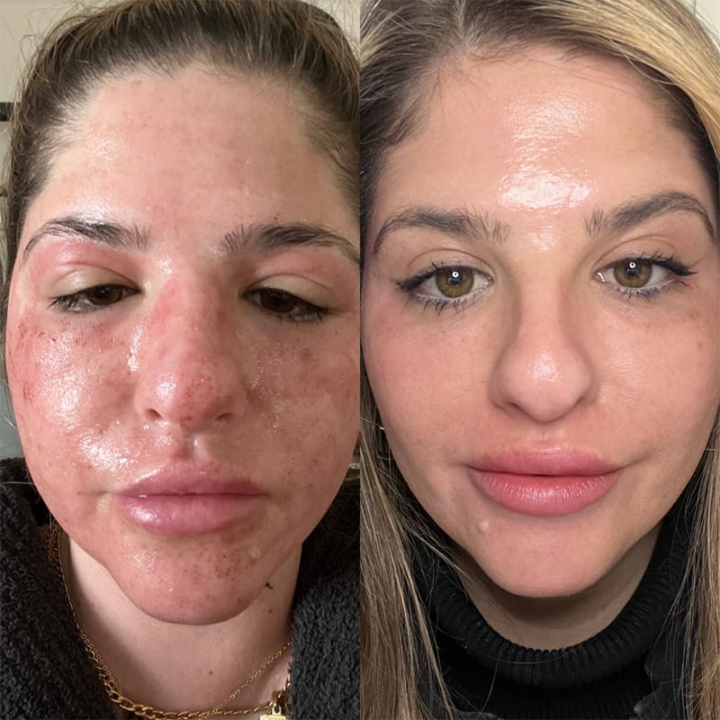 Real CO2 Resurfacing Laser patient before and after