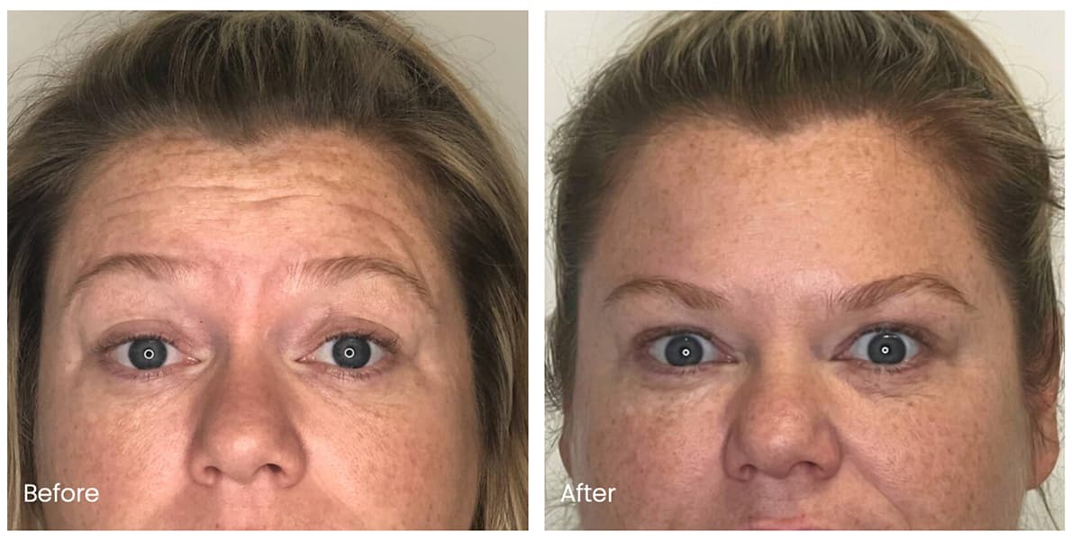 Real Botox patient before and after