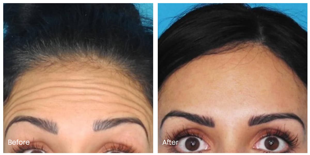 Real Botox patient before and after