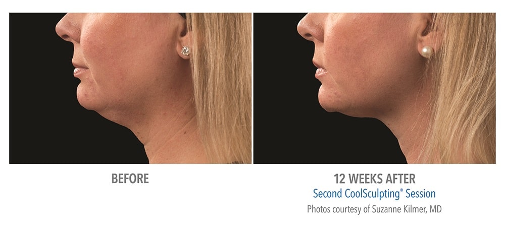 newtown CoolSculpting before and after patient results