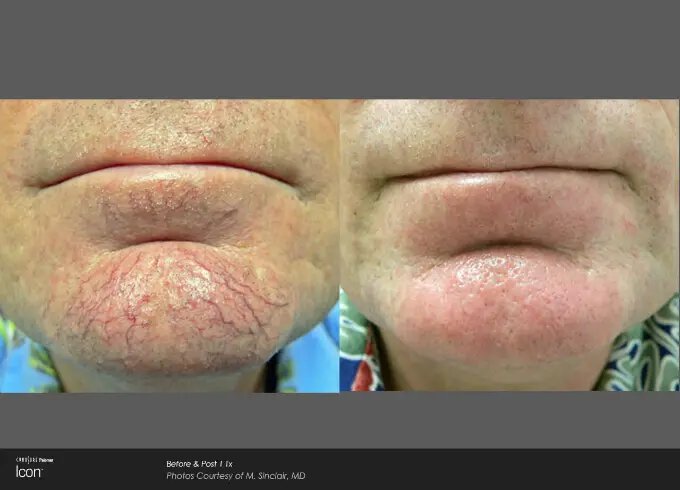 Newtown IPL photofacial patient for facial veins before and after