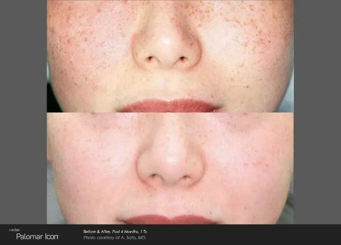 Newtown ipl photofacial patient before and after