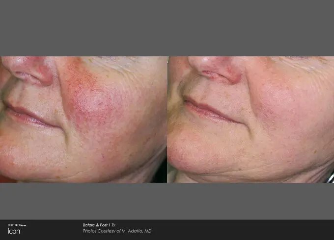 Newtown ipl photofacial patient for rosacea before and after