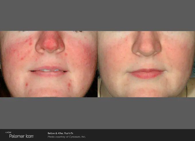 Newtown ipl photofacial patient before and after