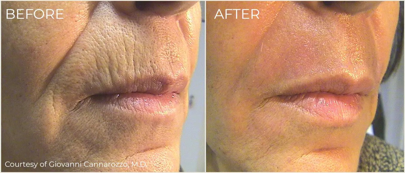 Newtown laser skin resurfacing patient