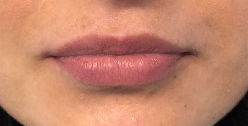 lip filler patient lips