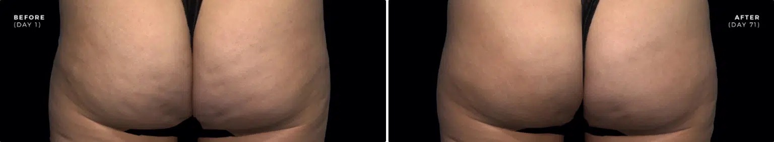 Qwo cellulite injection before and after3