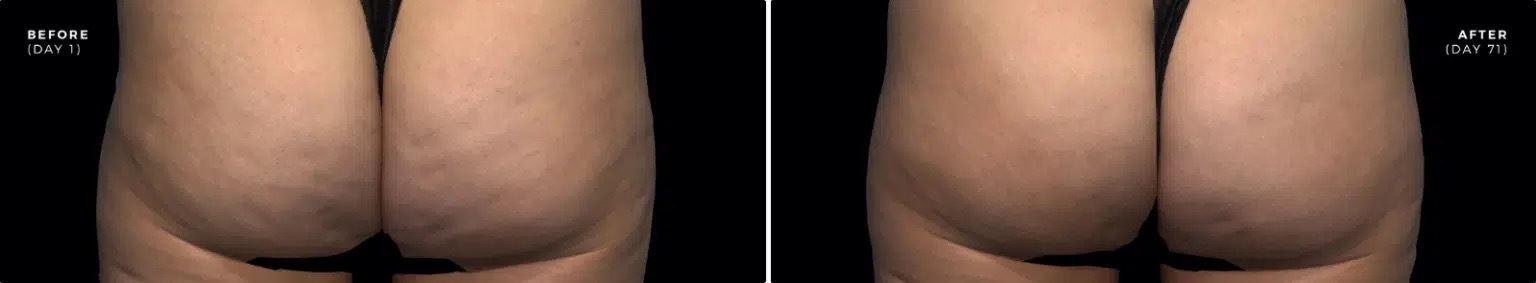 newtown Qwo Cellulite Injections patient results