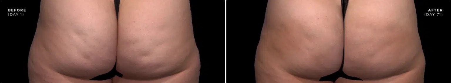 Qwo cellulite injection before and after1