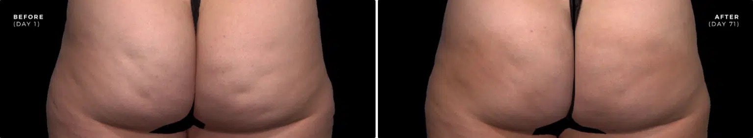 newtown Qwo Cellulite Injections patient results