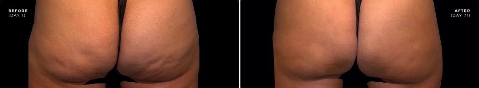 newtown Qwo Cellulite Injections patient results
