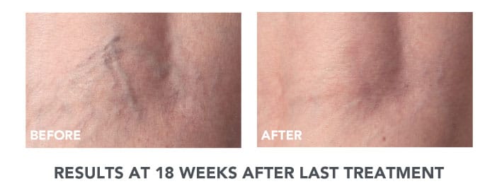 newtown sclerotherapy patient before and after