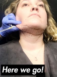 newtown kybella injections patient