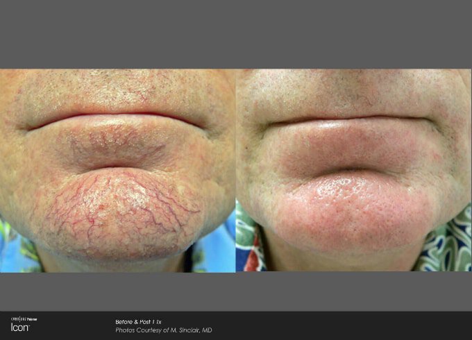 newtown facial vein patient results