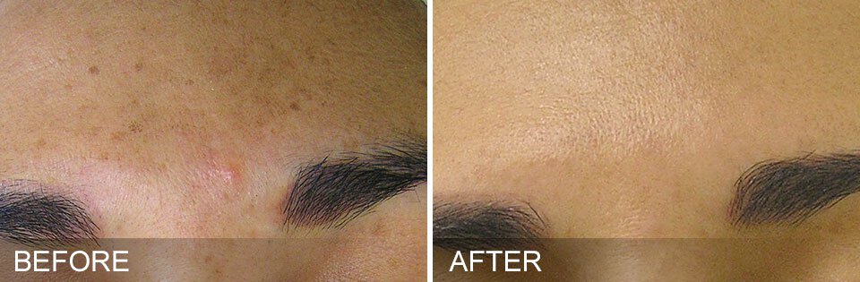 newtown patient brown spots before and after results