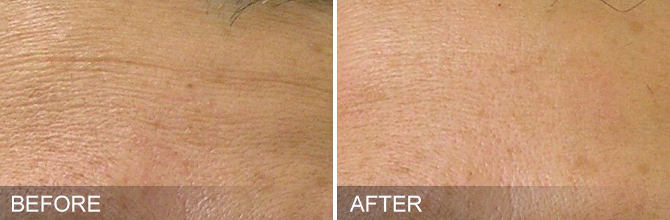 newtown HydraFacial patient before and after results