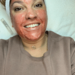 Microneedling model smiling