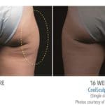 coolsculpting model results