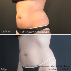 Newtown coolsculpting before and after