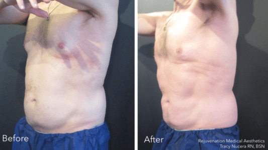 Newtown coolsculpting before and after