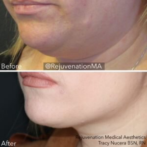 Newtown coolsculpting before and after