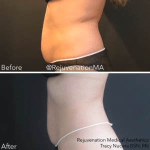 Coolsculpting before and after newtown