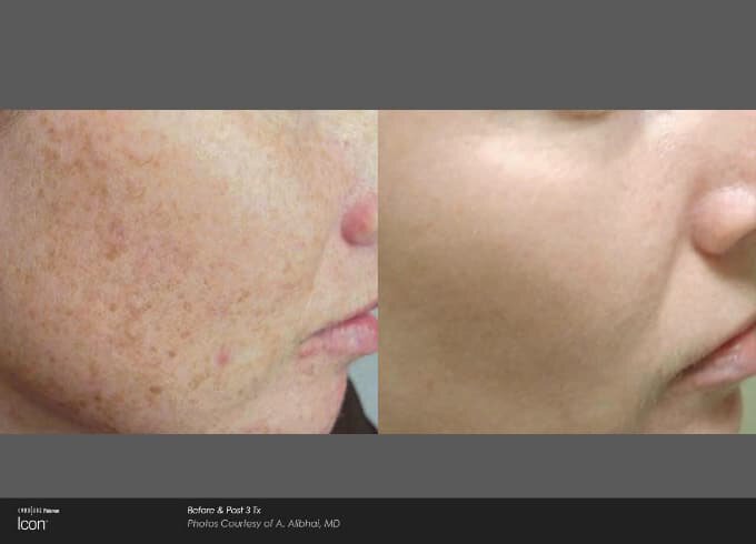 newtown hyperpigmentation patient results