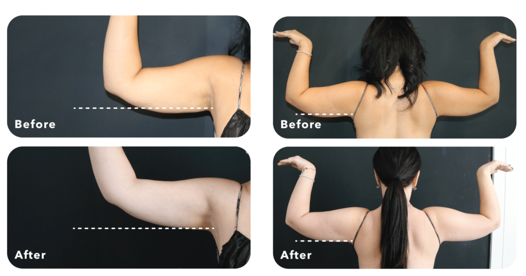 Newtown coolsculpting before and afters