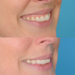 before and after smile treatment