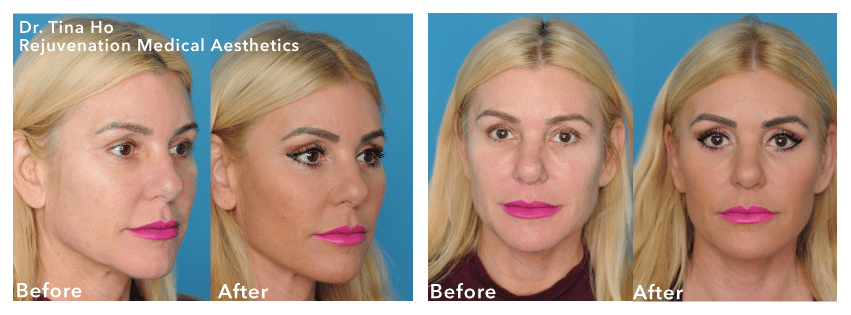 newtown liquid facelift results