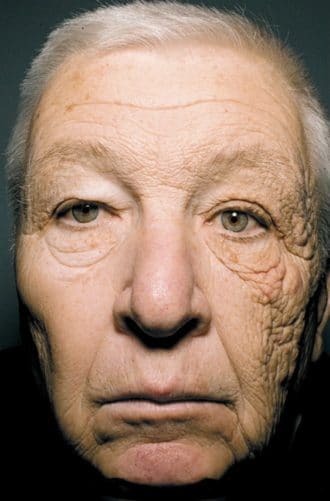 newtown sun burn patient