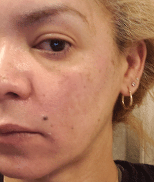 Newtown chemical peel results