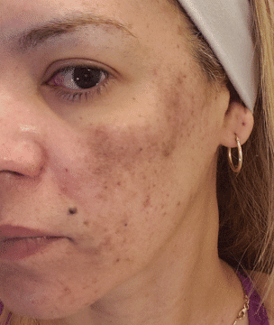 Newtown chemical peel results