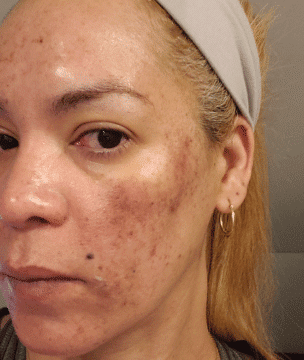 Newtown chemical peel results