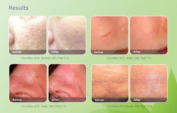 newtown acne patient results