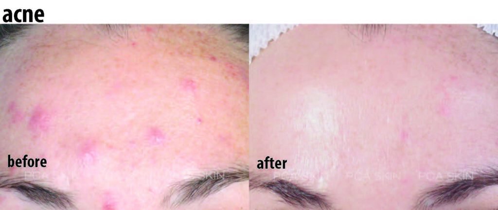 Newport chemical peel acne treatment patient before and after