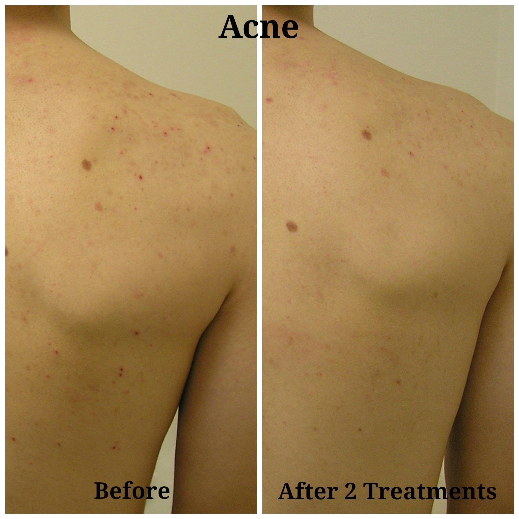 Newtown HydraFacial patient for acne treatment before and after