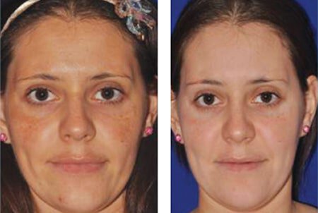 Newtown microneedling patient before and after