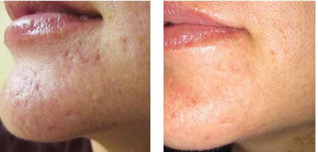 Newtown microneedling patient before and after