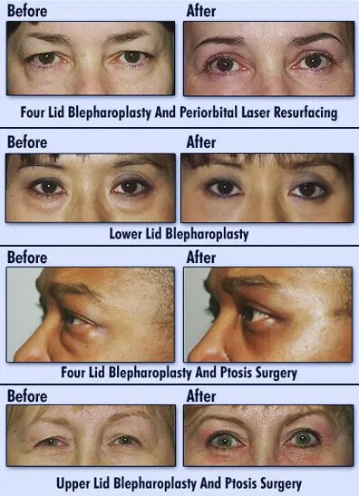 Newport blepharoplasty before and after