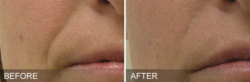 Newtown hydrafacial patient before and after