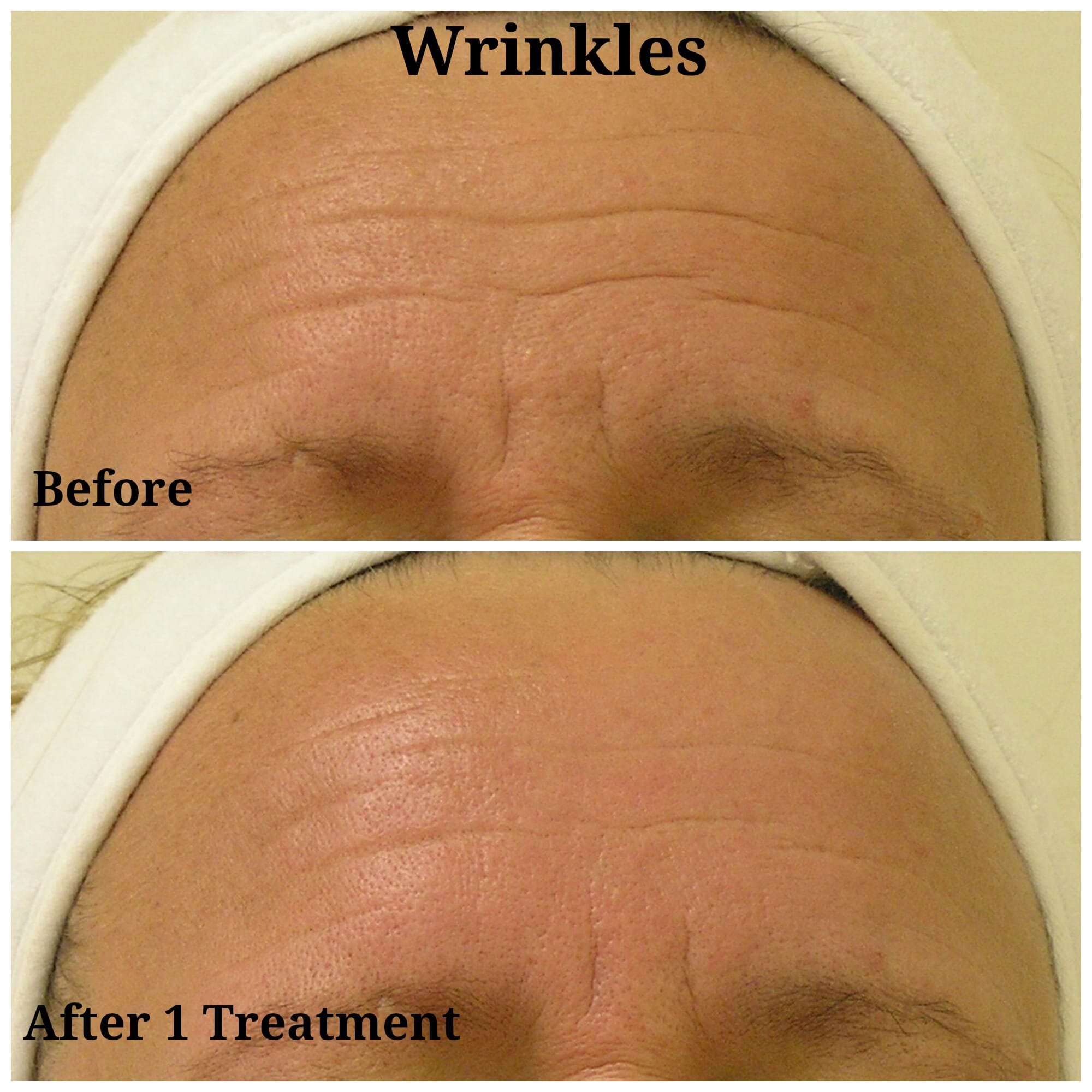 Newtown Hydrafacial patient for forehead wrinkles treatment before and after