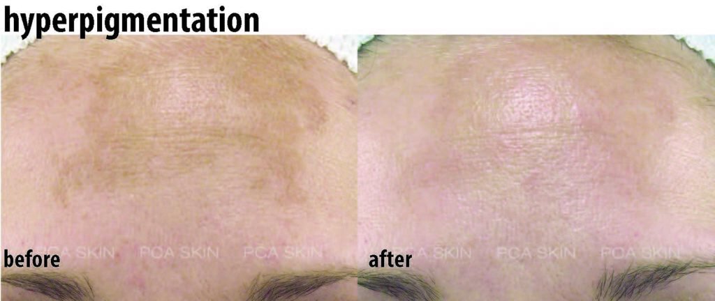 Newtown chemical peel HyperPigmentation treatment patient before and after
