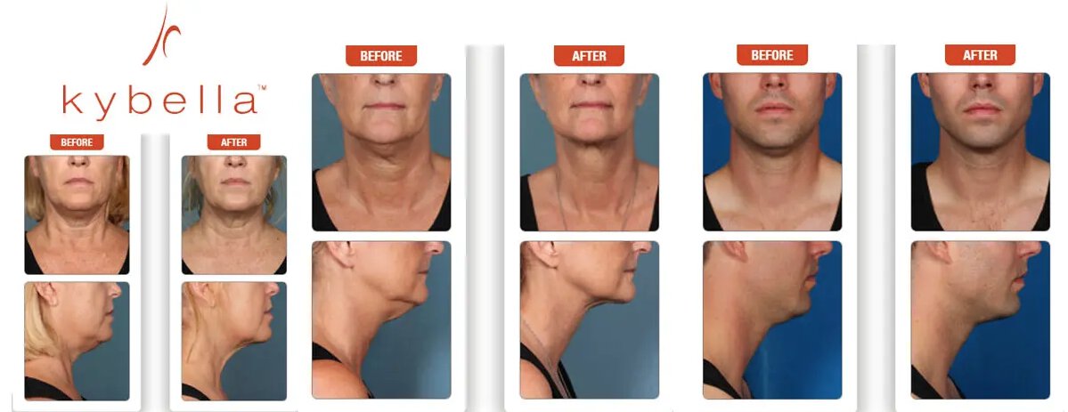 kybella results