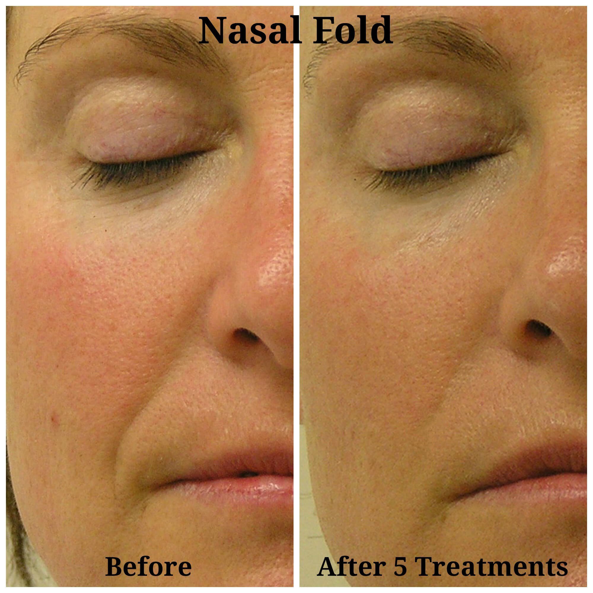 Nasal-Fold-Before-After1
